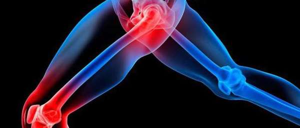 Симптомы и лечение генерализованного остеоартроза